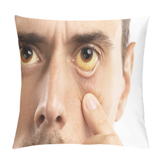 Personality  Yellowish Eyes Is Sign Of Problems With Liver, Viral Infection O Pillow Covers