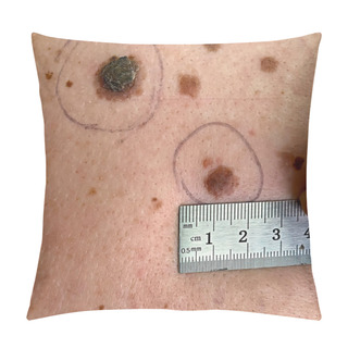 Personality  Measuring The Size Of A Mole On Human Skin. Pillow Covers