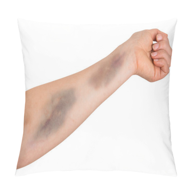 Personality  Large Bruise On Human Arm Pillow Covers