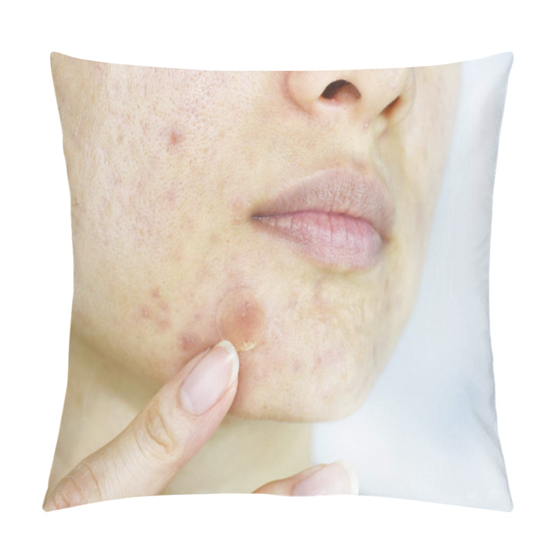 Personality  Facial Skin Problem, Close Up Woman Face With Whitehead Pimples And Acne Patch, Scar And Oily Greasy Face, Beauty Concept. Pillow Covers