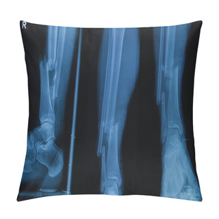 Personality  Collection Of Human X-rays  Showing Fracture Of Right Leg ( Frac Pillow Covers