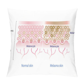 Personality  Normal Skin Layer And Melasma Skin Layer Vector, Melanocyte, Melanin, Melanogenesis Vector On White Background. Pillow Covers