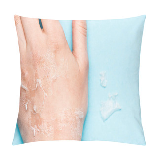 Personality  Cropped View Of Female Hand With Dead, Exfoliated Skin On Blue Pillow Covers