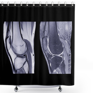 Personality  Magnetic Resonance Imaging Or MRI Knee Comparison Sagittal PDW And TIW View For Detect Tear Or Sprain Of The Anterior Cruciate  Ligament (ACL).clipping Path. Shower Curtains