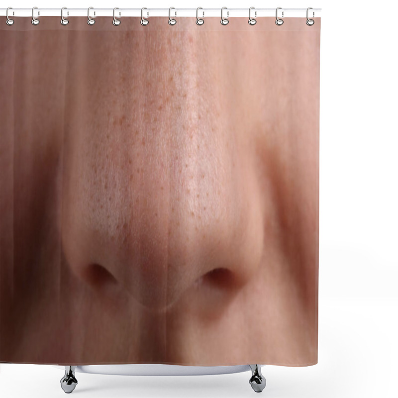 Personality  Young Woman With Acne Problem, Closeup View Of Nose Shower Curtains