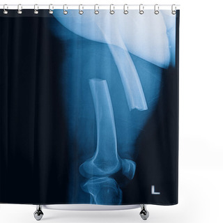 Personality  Broken Human Thigh X-rays Image ,lelf Leg Fracture Shower Curtains