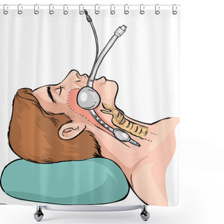 Personality  Technique Of Tubal Intubation Shower Curtains