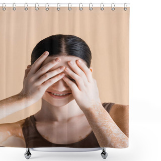 Personality  Smiling Young Beautiful Woman With Vitiligo Covering Eyes Isolated On Beige Shower Curtains