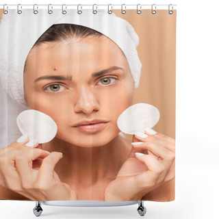 Personality  Young Woman With Pimple On Face Holding Cotton Pads Isolated On Beige  Shower Curtains