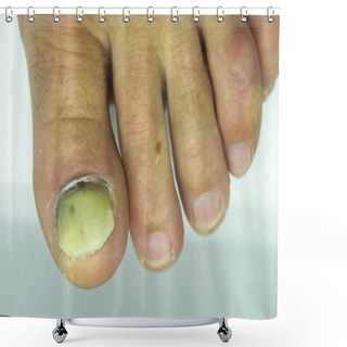 Personality  Damaged Toenail. The Thumb On The Mans Leg. Ugly, Injured And Broken Nail On The Foot. Shower Curtains