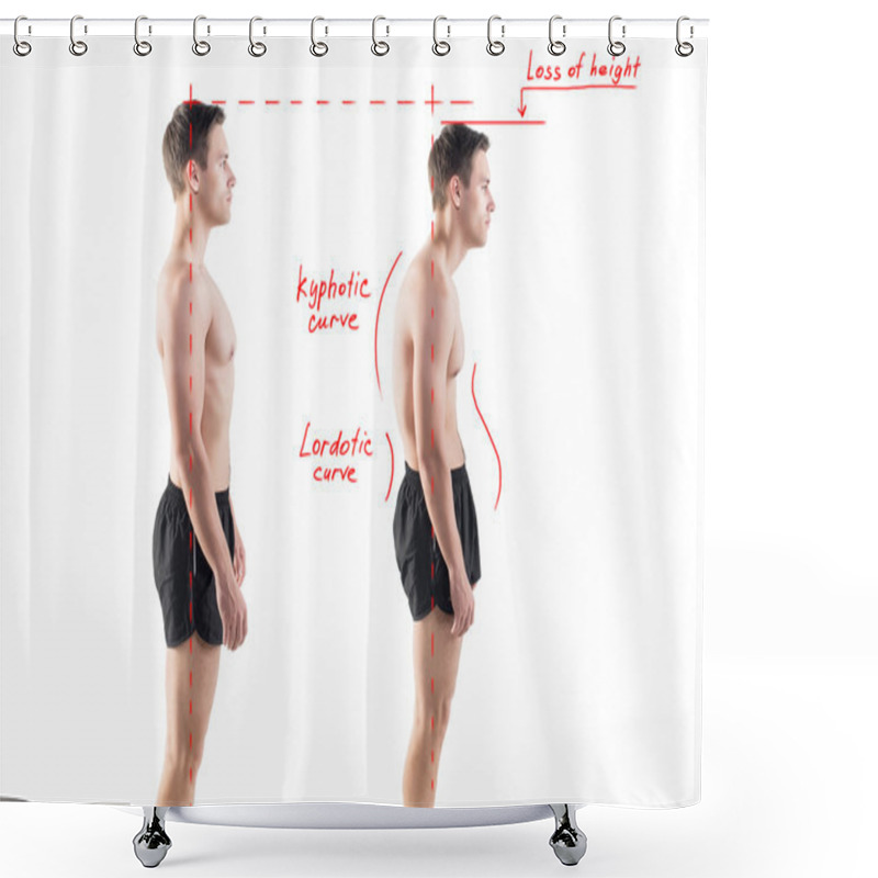 Personality  Man With Impaired Posture Position Defect Scoliosis And Ideal Bearing Shower Curtains