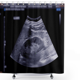 Personality  Ultrasound Upper Abdomen Showing  Kidney. Shower Curtains