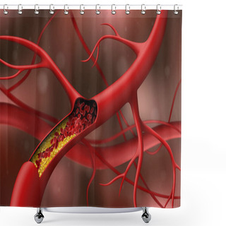 Personality  Artery Blocked By Cholesterol. Vector Illustration Shower Curtains