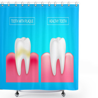 Personality  Tooth With Plaque And Healthy Tooth Comparision.  Teeth Whitening. Dental Care Concept. Oral Care, Teeth Restoration. Yellow And White Teeth. Shower Curtains