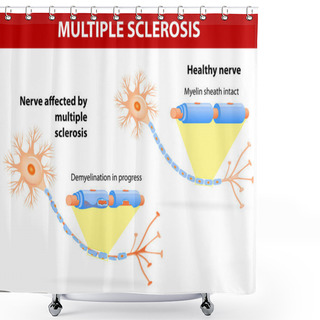 Personality  Nerve Affected By Multiple Sclerosis Shower Curtains