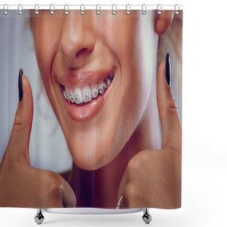 Personality  Close View Of Smiling Woman With Braces On Teeth Shower Curtains
