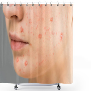 Personality  Close Up Of Young Woman With Pimples On Face Isolated On Grey  Shower Curtains