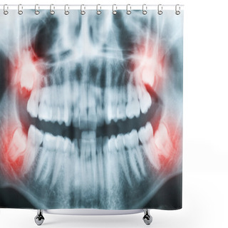 Personality  Closeup Of X-ray Image Of Teeth And Mouth With All Four Molars V Shower Curtains