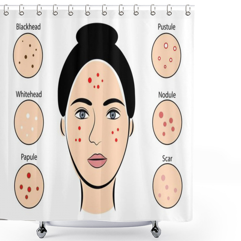 Personality  Girl With Acne On White Background. Vector Illustration Shower Curtains