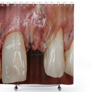 Personality  Tooth Surgery Implant View Shower Curtains