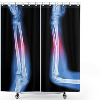 Personality  Fracture Shaft Of Ulnar Bone ( Forearm Bone )  :  ( Front And Side View ) Shower Curtains