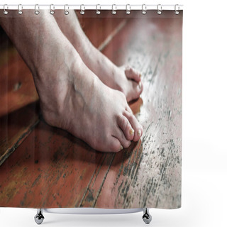 Personality  Barefoot Which Have Bunion (hallux Valgus) Problem On Wooden Brown Floor. Deformation Of The Joint Connecting The Big Toe To The Foot Shower Curtains