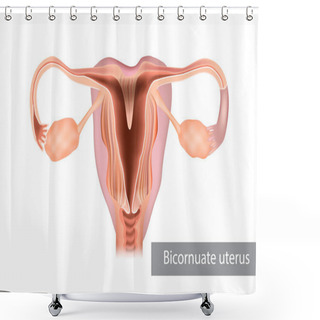 Personality  A Bicornuate Uterus Or Bicornate Uterus Is A Type Of Mullerian Anomaly In The Human Uterus. Illustration, Female Reproductive Organ Shower Curtains