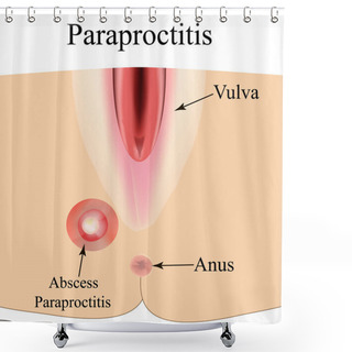 Personality  Paraproctitis. Abscess In The Perineum. Inflammation Paraproctitis. Infographics. Vector Illustration On Isolated Background. Shower Curtains