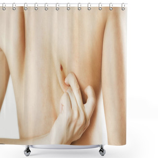 Personality  Birthmark On The Female Back, Fibroma, Close-up Shower Curtains