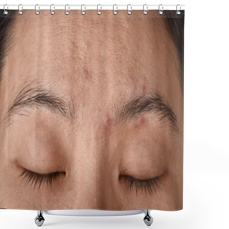 Personality  Facial Skin Problem, Aging Problem In Adult, Wrinkle, Acne Scar, Large Pore And Dark Spot, Dehydrate Skin. Shower Curtains