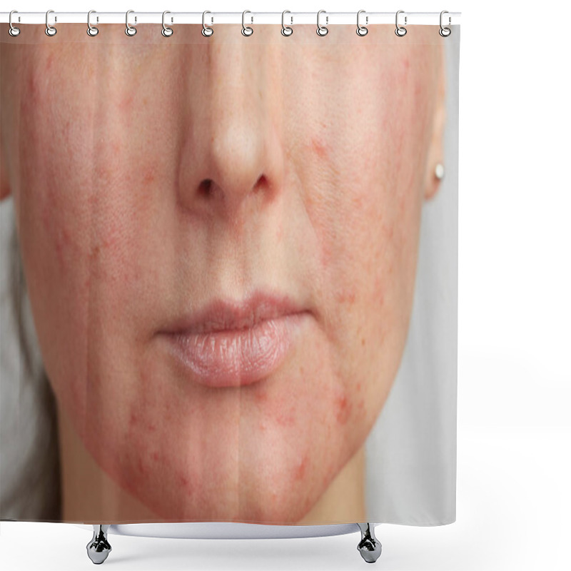 Personality  Acne On A Girl Face Closeup Shower Curtains