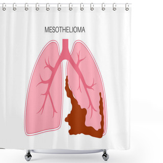 Personality  Mesothelioma Tumor Cells Poster. Lung Cancer Concept. Respiratory System Illness. Asbestos Related Diseases. Shortness Of Breath, Pain In Chest, Breathing Problem, Medical Flat Vector Illustration. Shower Curtains