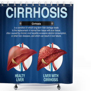 Personality  Cirrhosis Of The Liver Infographic Illustration Shower Curtains