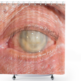 Personality  Phthisis Bulbi At Eye Test Shower Curtains