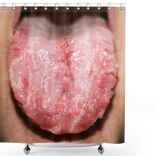 Personality  Geographic Tongue, Candidiasis, The Language Of The White Coating Candida Shower Curtains