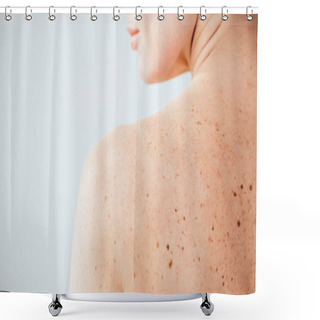 Personality  Cropped View Of Diseased And Naked Woman With Moles On Skin On White  Shower Curtains