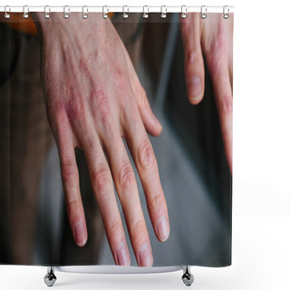 Personality  High Angle View Of Hands Suffering The Dryness On The Skin And Deep Cracks On Knuckles. Eczema Or Psoriasis On Hands Shower Curtains
