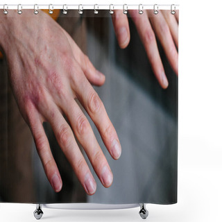 Personality  High Angle View Of Hands Suffering The Dryness On The Skin And Deep Cracks On Knuckles. Eczema Or Psoriasis On Hands Shower Curtains