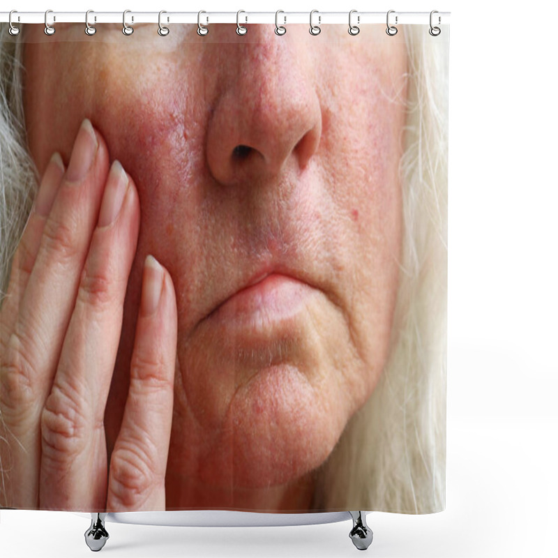 Personality  Red Veins, Spots And Operation Scars On The Face Of An Older Woman Shower Curtains