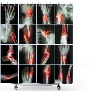 Personality  Collection X-ray Multiple Bone Fracture (finger,spine,wrist,hip,leg,clavicle,ankle,elbow,arm,foot) Shower Curtains