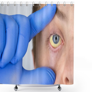 Personality  The Yellow Color Of The Male Eye. Symptom Of Jaundice, Hepatitis Or Problems With The Gall Bladder, Gastrointestinal Tract, Liver. Shower Curtains