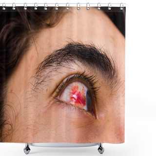 Personality  Subconjunctival Hemorrhage Shower Curtains