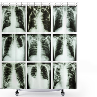 Personality  Collection Of Lung Disease (Pulmonary Tuberculosis,Pleural Effusion,Bronchiectasis) Shower Curtains