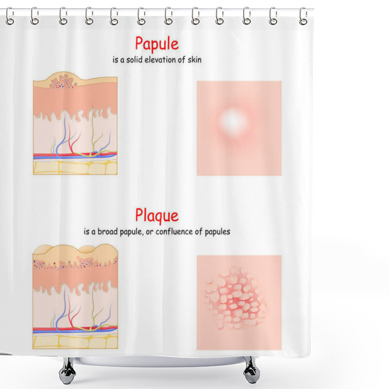 Personality  Skin Lesion. Papule And Plaque. Side And Top View. Cross Section Of The Human Skin. Papule Is A Solid Elevation Of Skin. Plaque Is A Broad Papule. Shower Curtains