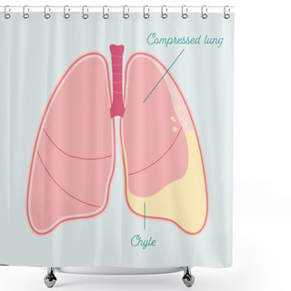 Personality  Chylothorax In Human Lung. Accumulation Of Lymph In Pleural Space - Vector Anatomical Scheme Shower Curtains