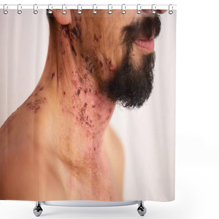 Personality  Man With Shingles Virus Shower Curtains