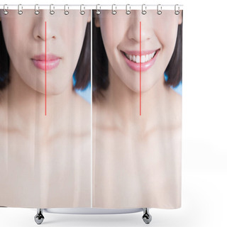 Personality  Surgery Of Chin Asymmetry  Shower Curtains