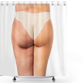 Personality  Cellulite Problem Concept, Before And After Shower Curtains