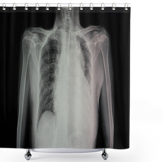 Personality  A Chest X-ray Film  Of A Patient With Cardiomegaly With Left Side Heart Failure, Pulmonary Edema, And Pericadial Effusion Shower Curtains