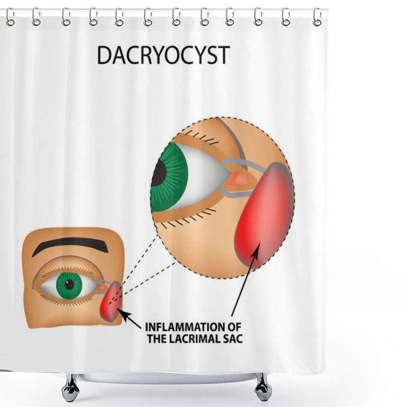 Personality  Dacryocyst. Inflammation Of The Lacrimal Sac Of The Eye. The Structure Of The Eye. Infographics. Vector Illustration On Isolated Background Shower Curtains